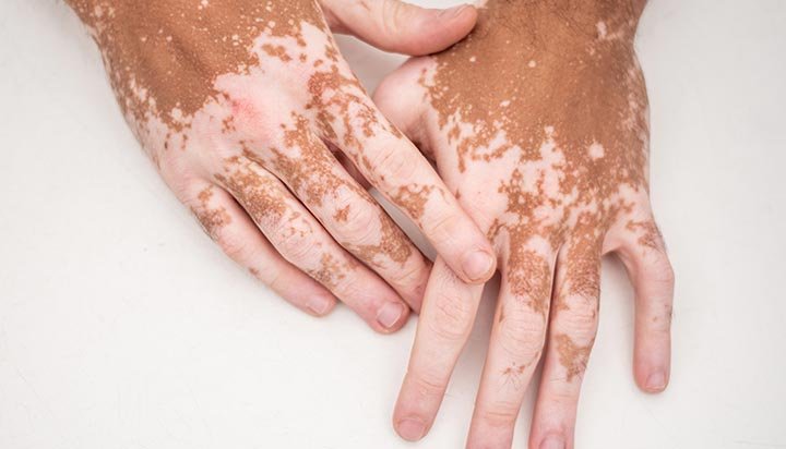 Monobenzone for Vitiligo: What Patients Should Know Before Depigmentation Therapy